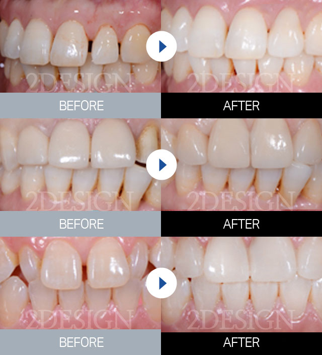 before & after
