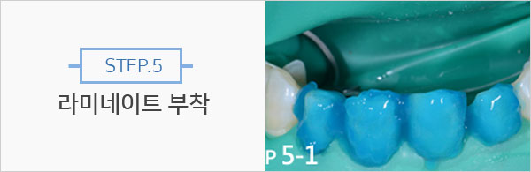 STEP.5 라미네이트 부착